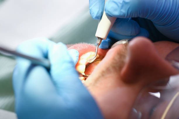 Best Emergency Root Canal Treatment in Linthicum, MD